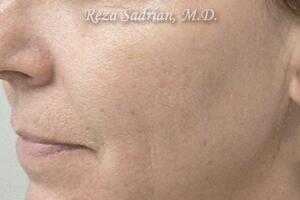 Laser Resurfacing Before & After Image