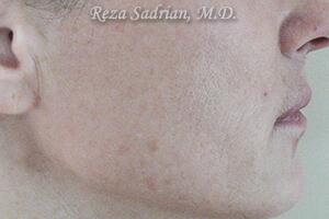 Laser Resurfacing Before & After Image