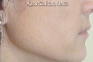 Laser Resurfacing Before & After Image