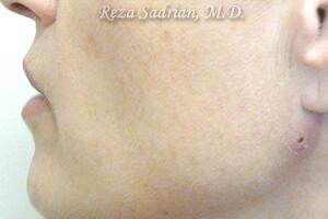 Laser Resurfacing Before & After Image