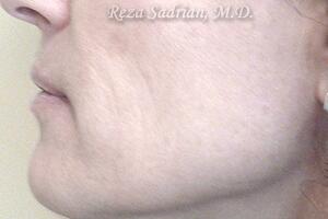 Laser Resurfacing Before & After Image