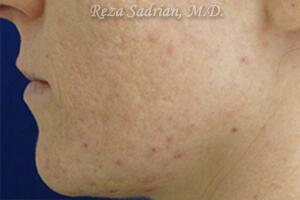 Laser Resurfacing Before & After Image