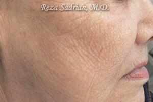 Laser Resurfacing Before & After Image