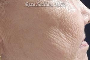 Laser Resurfacing Before & After Image