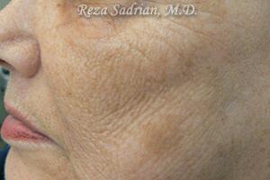 Laser Resurfacing Before & After Image