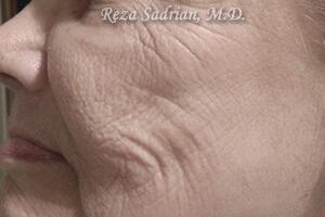 Laser Resurfacing Before & After Image