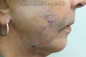 Laser Vein Removal Before & After Image