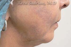 Laser Vein Removal Before & After Image