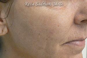 Micro Laser Peel Before & After Image