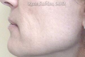 Micro Laser Peel Before & After Image