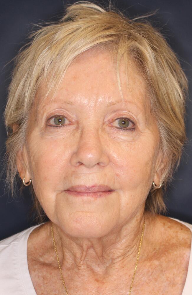 Profractional Laser Before & After Image