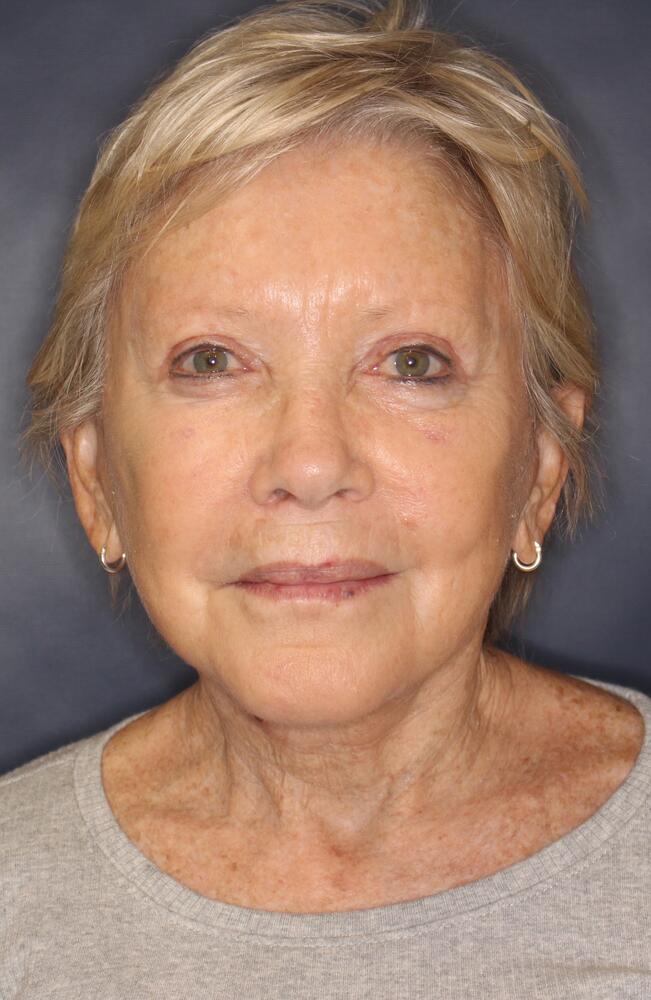Profractional Laser Before & After Image