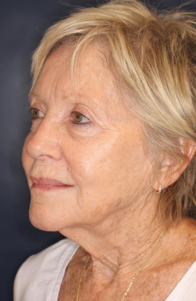 Profractional Laser Before & After Image