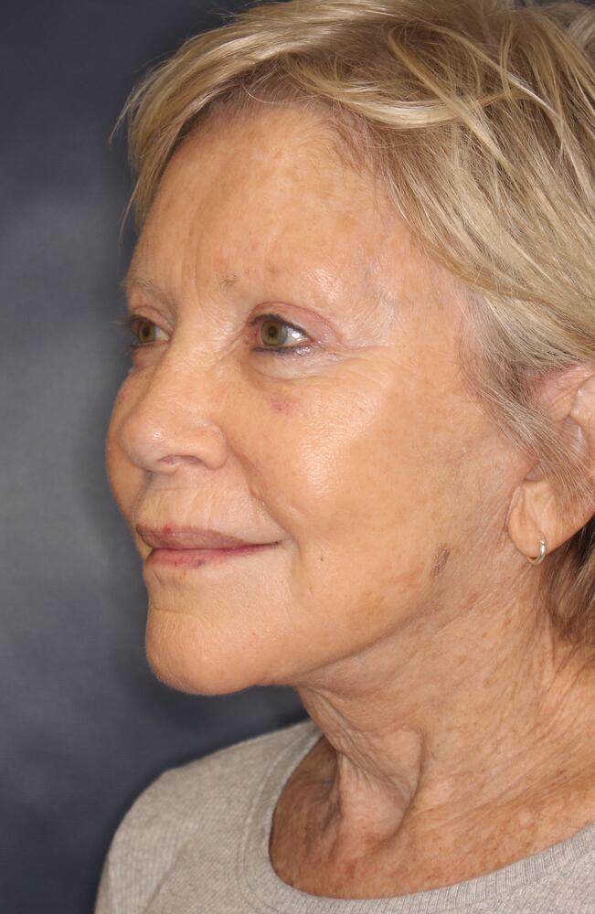 Profractional Laser Before & After Image
