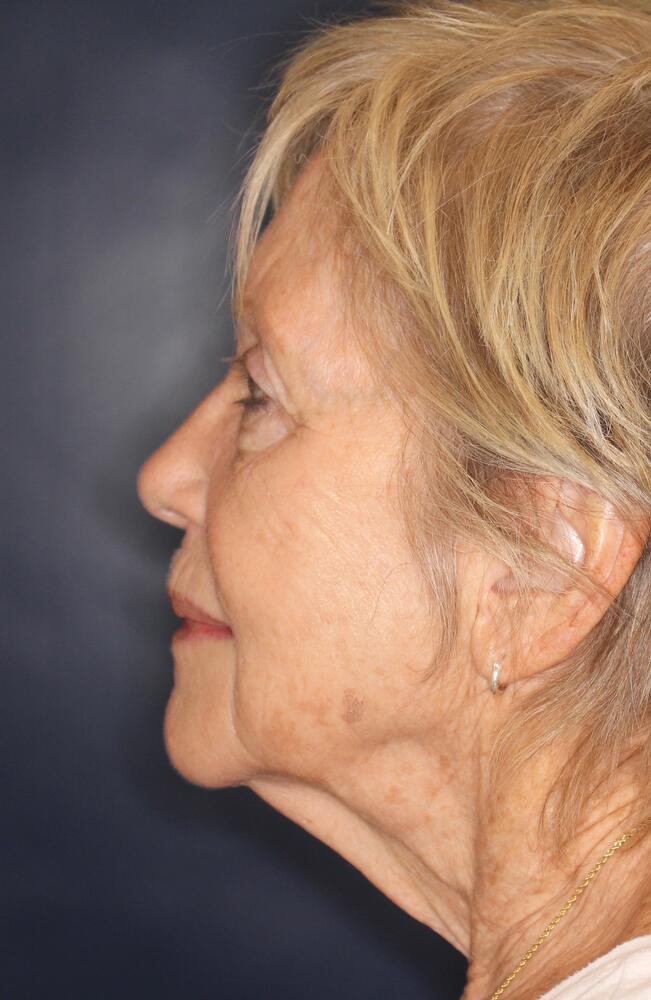 Profractional Laser Before & After Image
