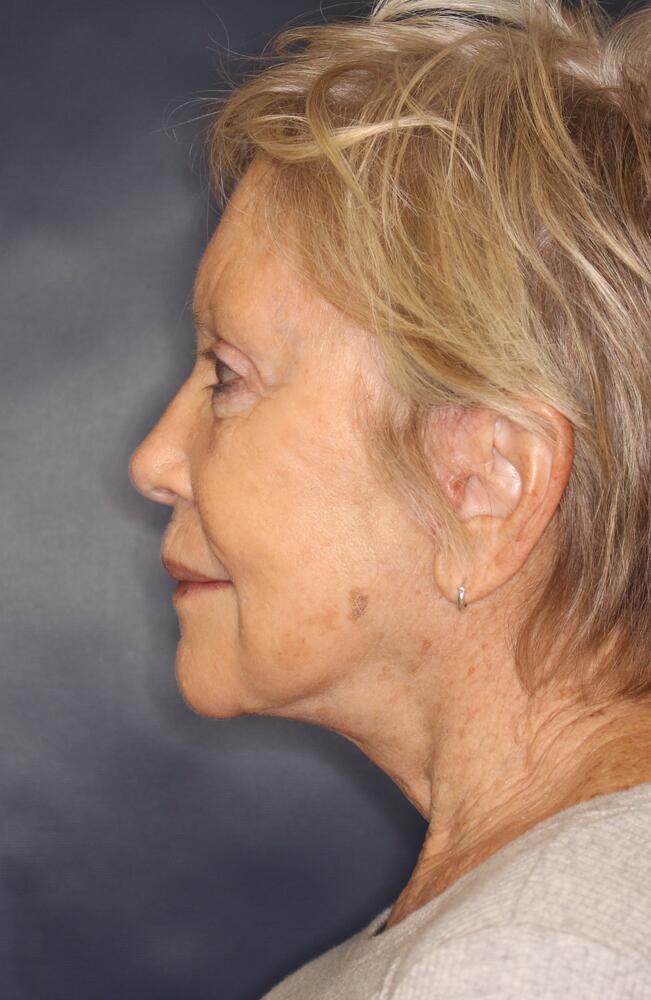 Profractional Laser Before & After Image